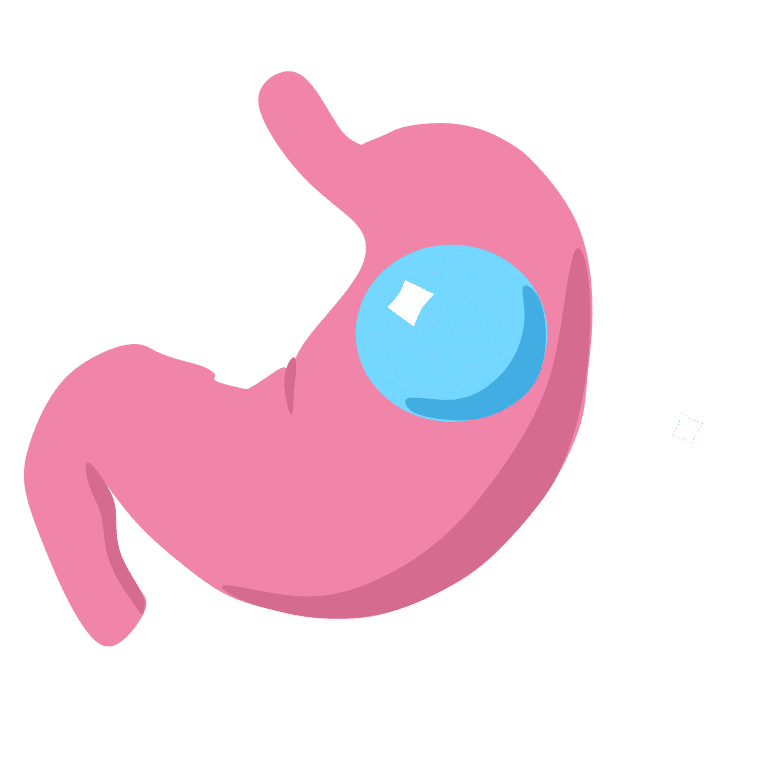 ilustrasi gastric balloon atau balon lambung (commons.wikimedia.org/Lina Wolf, magenverkleinerung.tips)