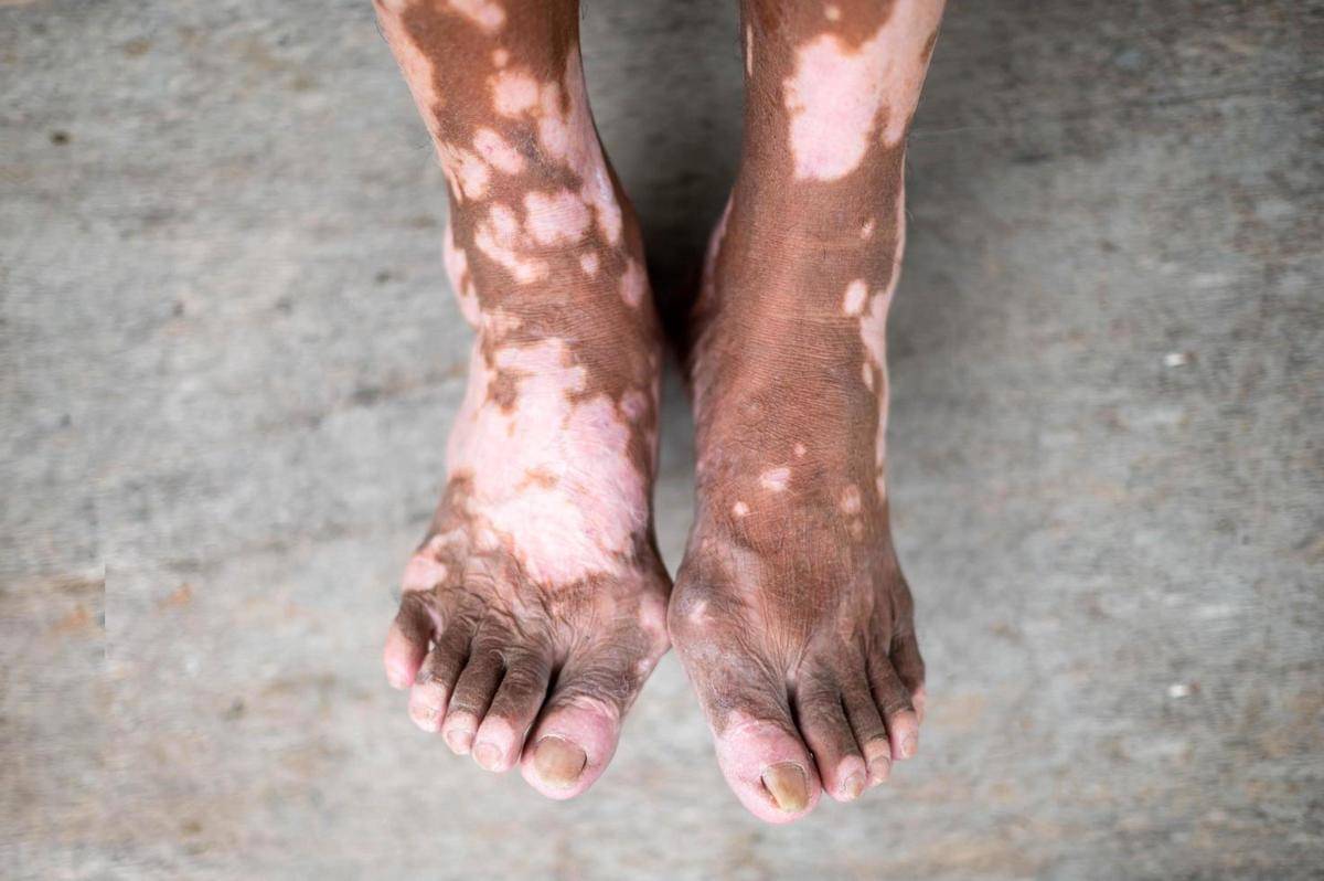 ilustrasi vitiligo (vecteezy.com/Phongsaya Limpakhom)