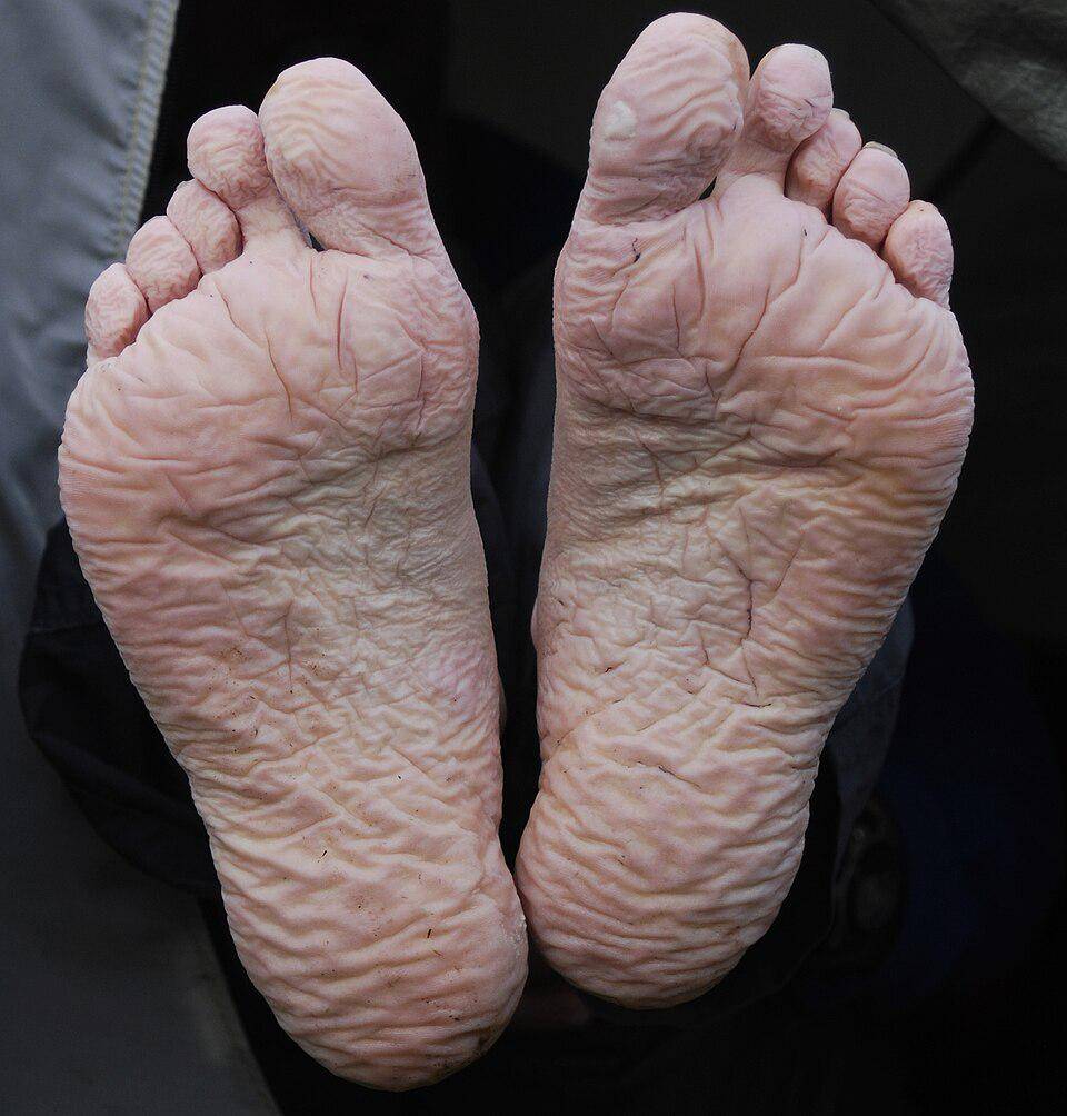 ilustrasi trench foot (commons.wikimedia.org/Mehmet Karatay)