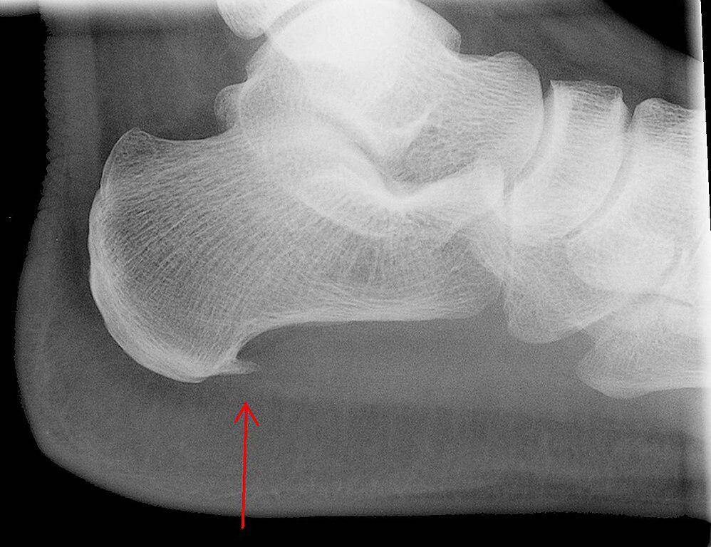 Gambar sinar-X tulang tumit dengan plantar fasciitis. (commons.wikimedia.org/Lucien Monfils)