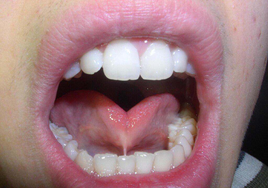 ilustrasi tongue tie (commons.wikimedia.org/Klaus Peter-Kuttig, Wiehl, Germany)