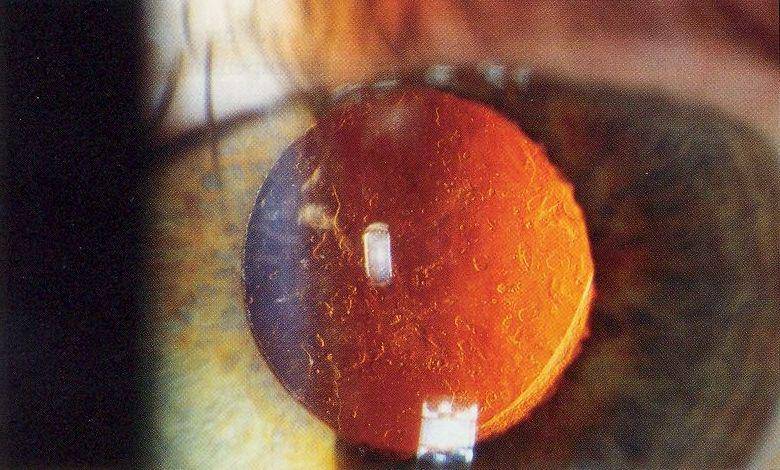 Opasifikasi kapsul posterior (PCO), after cataract, katarak sekunder. (commons.wikimedia.org/Rakesh Ahuja, MD)