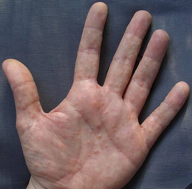 640px-Dyshidrosis.png