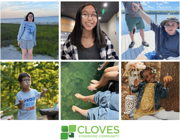 ilustrasi gejala sindrom cloves (clovessyndrome.org)