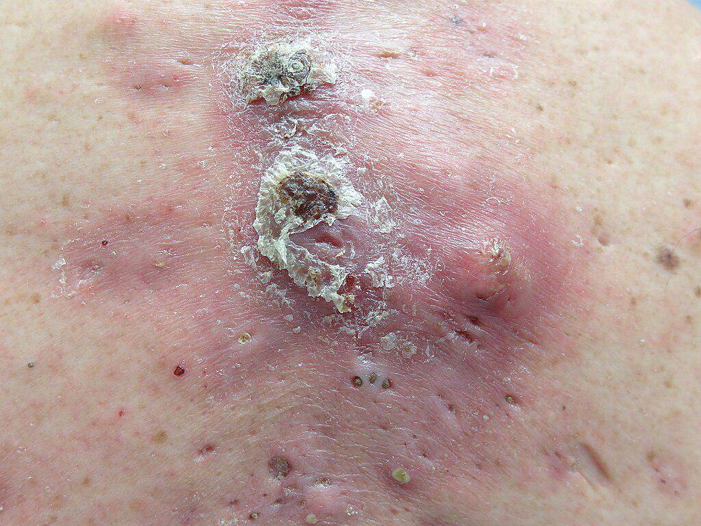 ilustrasi acne conglobata (commons.wikimedia.org/Dr. Thomas Brinkmeier)