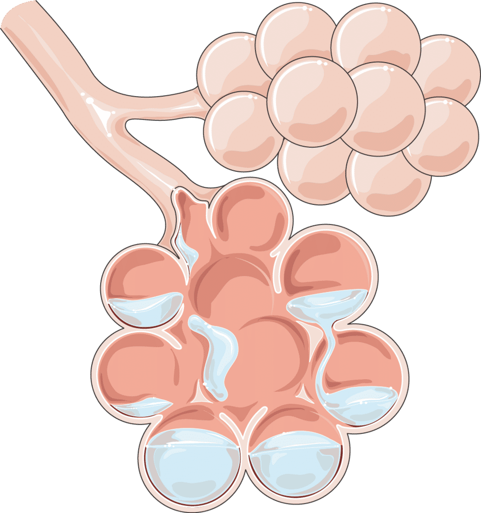 ilustrasi cairan di dalam alveoli (ruang udara) paru-paru dalam kasus edema paru (commons.wikimedia.org/SMART-Servier Medical Art)