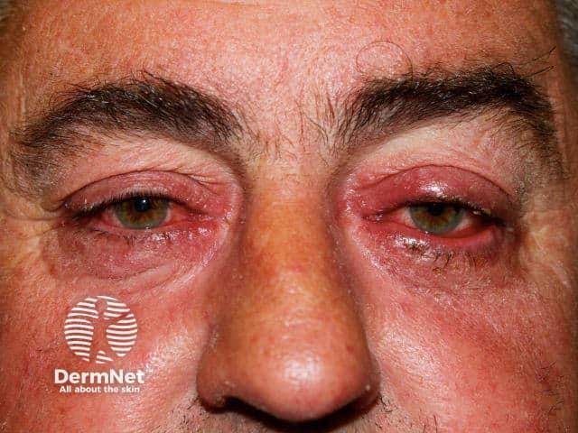 ilustrasi rosacea okular (dermnetnz.org)