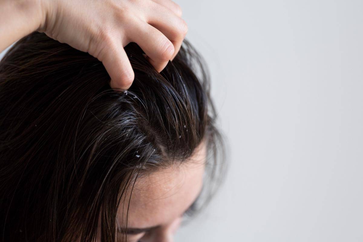 ilustrasi rambut kering dan gatal 