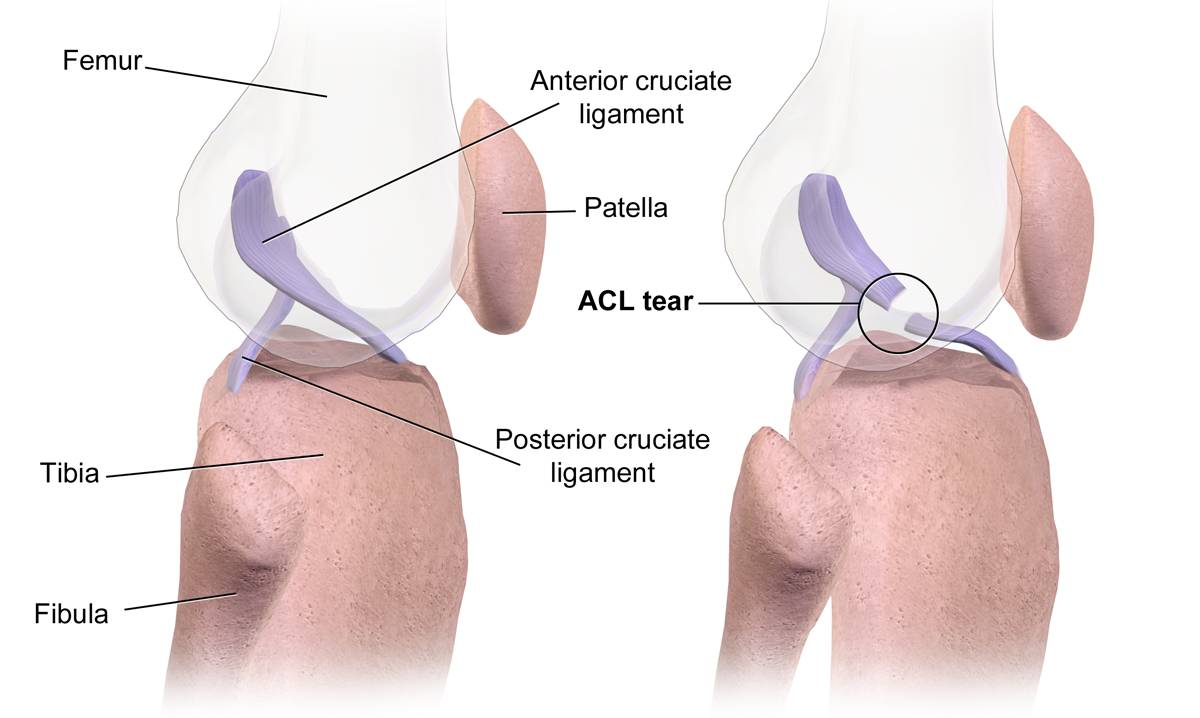 Cedera ACL robek. (commons.wikimedia.org/BruceBlaus)