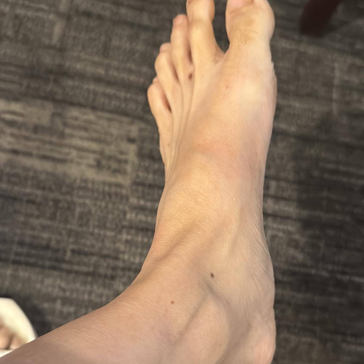 kondisi kaki Ussy Sulistiawaty yang cedera (instagram.com/ussypratama)