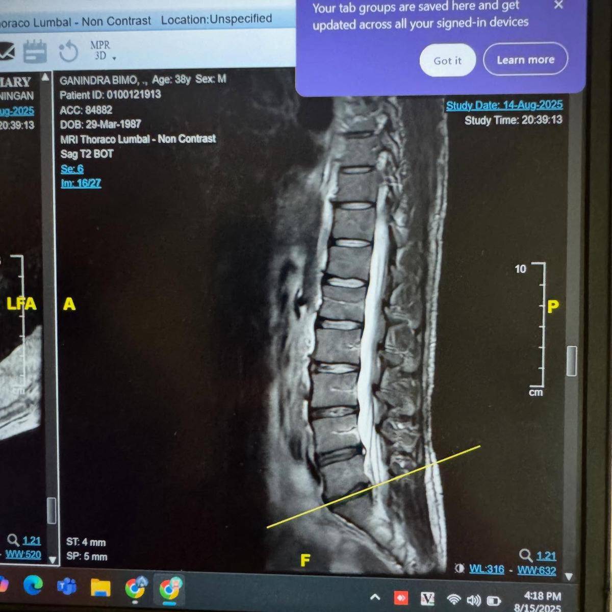 Ganindra Bimo operasi karena cedera pinggang (instagram.com/ganindrabimo)