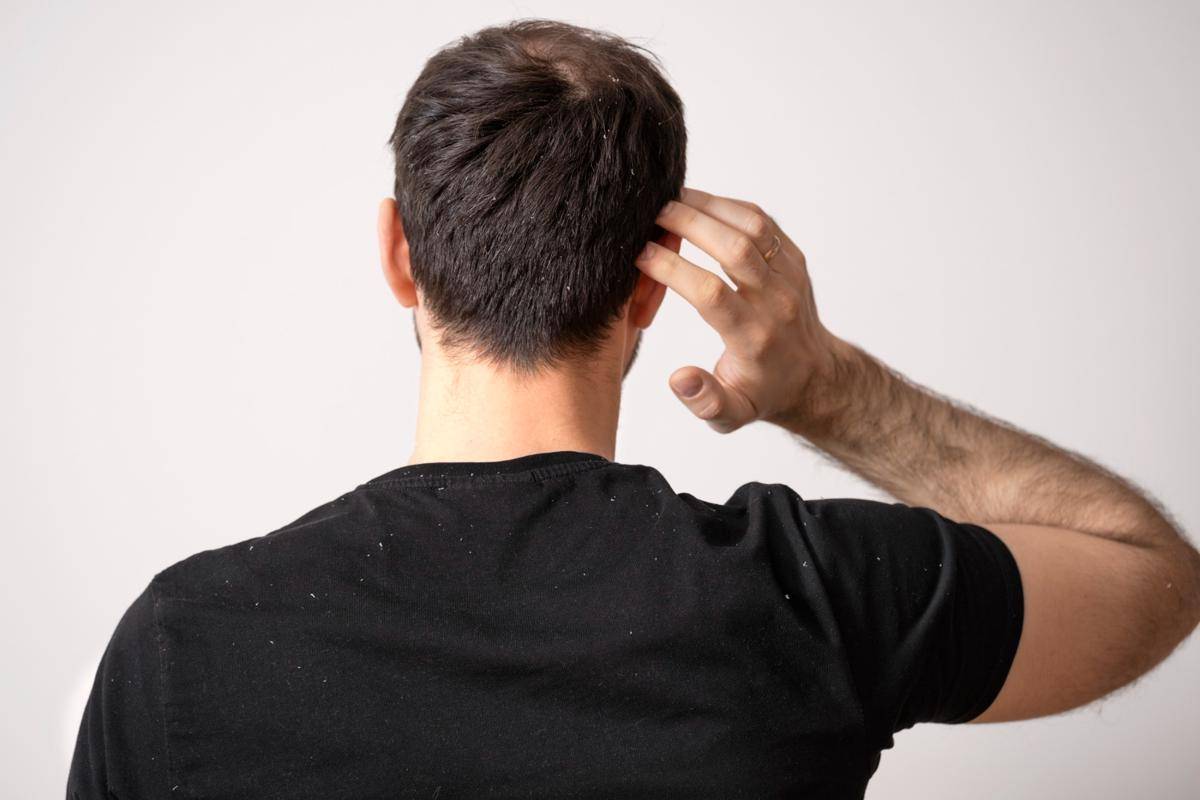 ilustrasi rambut pria mengalami kerusakan (freepik.com/freepik)