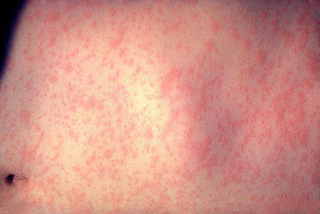 Kulit pasien setelah tiga hari terinfeksi campak. (commons.wikimedia.org/CDC/Dr. Heinz F. Eichenwald)