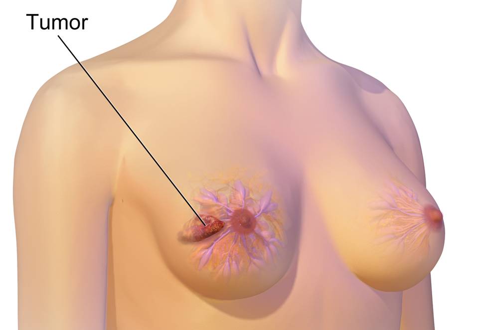 ilustrasi kanker payudara (commons.wikimedia.org/Bruce Blaus)