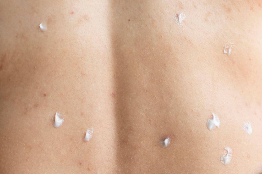 ilustrasi mengoleskan krim anti-acne ke jerawat di punggung (freepik.com/freepik)