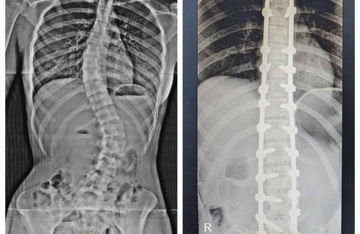 potret Nada Tarina operasi skoliosis