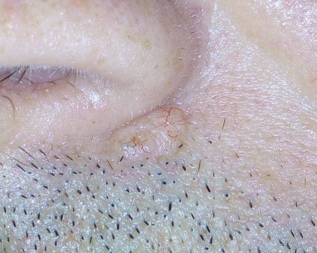 Karsinoma sel basal di area hidung. (commons.wikimedia.org/SkarmoutsosV)