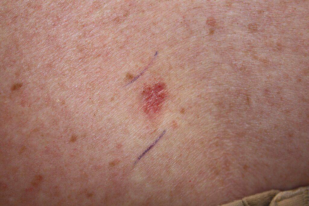 Karsinoma sel basal superfisial, jenis kanker kulit. (commons.wikimedia.org/National Cancer Institute, U.S. Department of Health and Human Services/Kelly Nelson, M.D.)