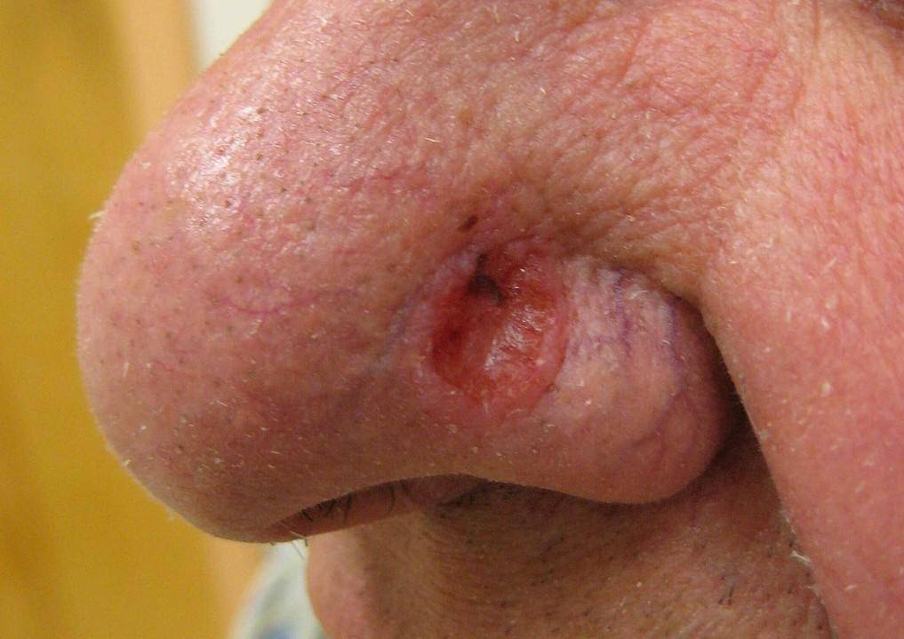 Karsinoma sel basal di hidung. (commons.wikimedia.org/James Heilman, MD)