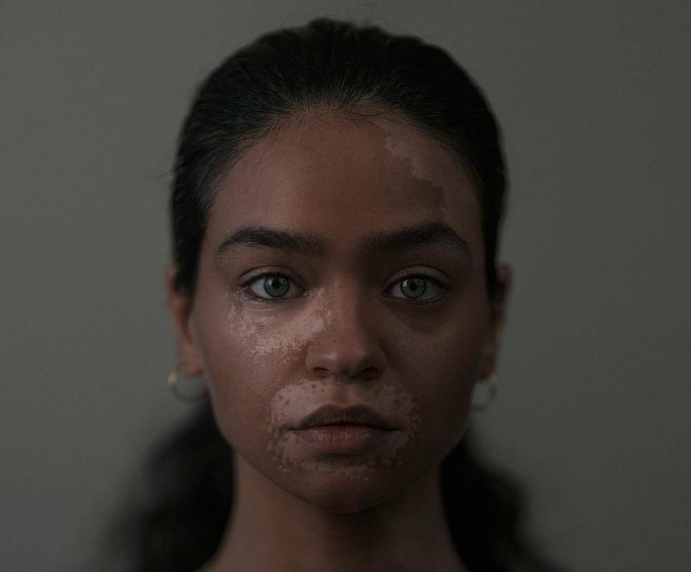 gambar seorang perempuan dengan vitiligo (unsplash.com/See Plus)