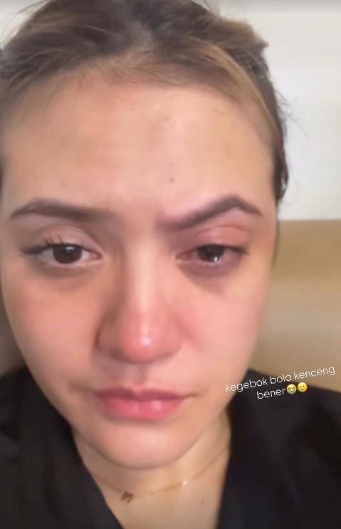 Mata Marsha Aruan Terkena Bola Padel (Instagram.com/aruanmarsha)