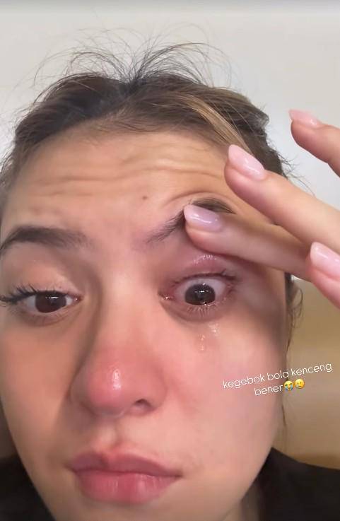 Mata Marsha Aruan Terkena Bola Padel (Instagram.com/aruanmarsha)