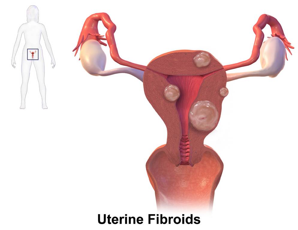 ilustrasi fibroid rahim atau mioma uteri (commons.wikimedia.org/BruceBlaus)