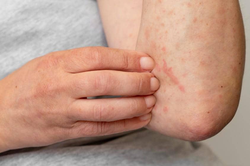 Ilustrasi ruam kulit, salah satu gejala awal HIV.