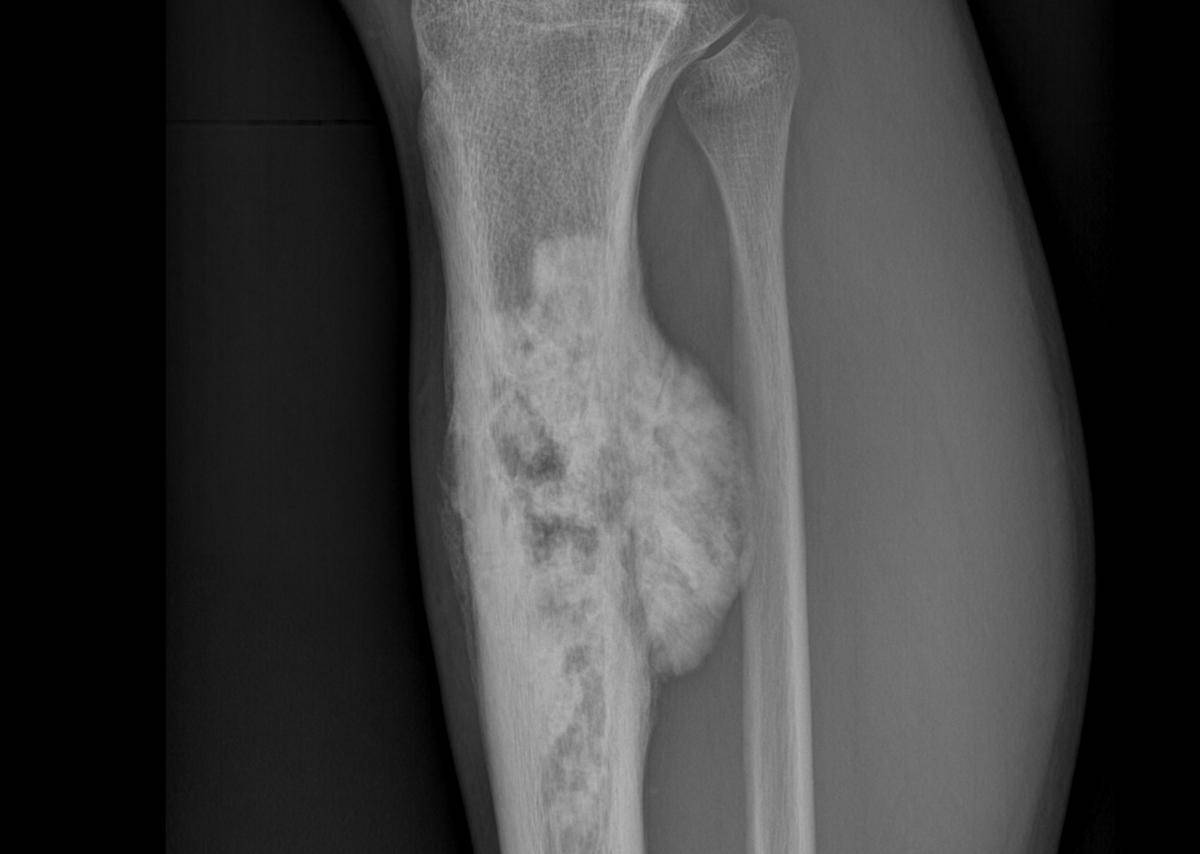Hasil pemindaian menunjukkan osteosarkoma di tulang kering.
