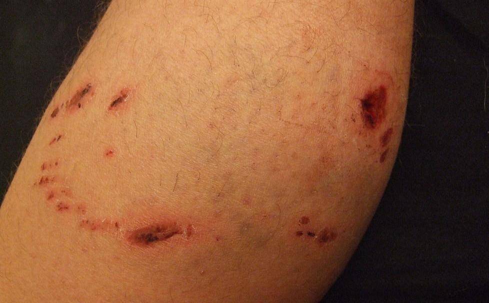Luka digigit anjing di kaki.