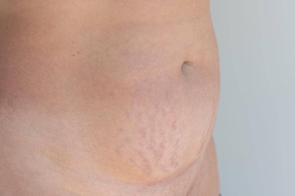 ilustrasi stretch mark (freepik.com/freepik)