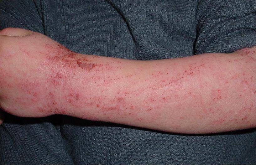 Gejala dermatitis atopik atau eksim pada kulit anak.