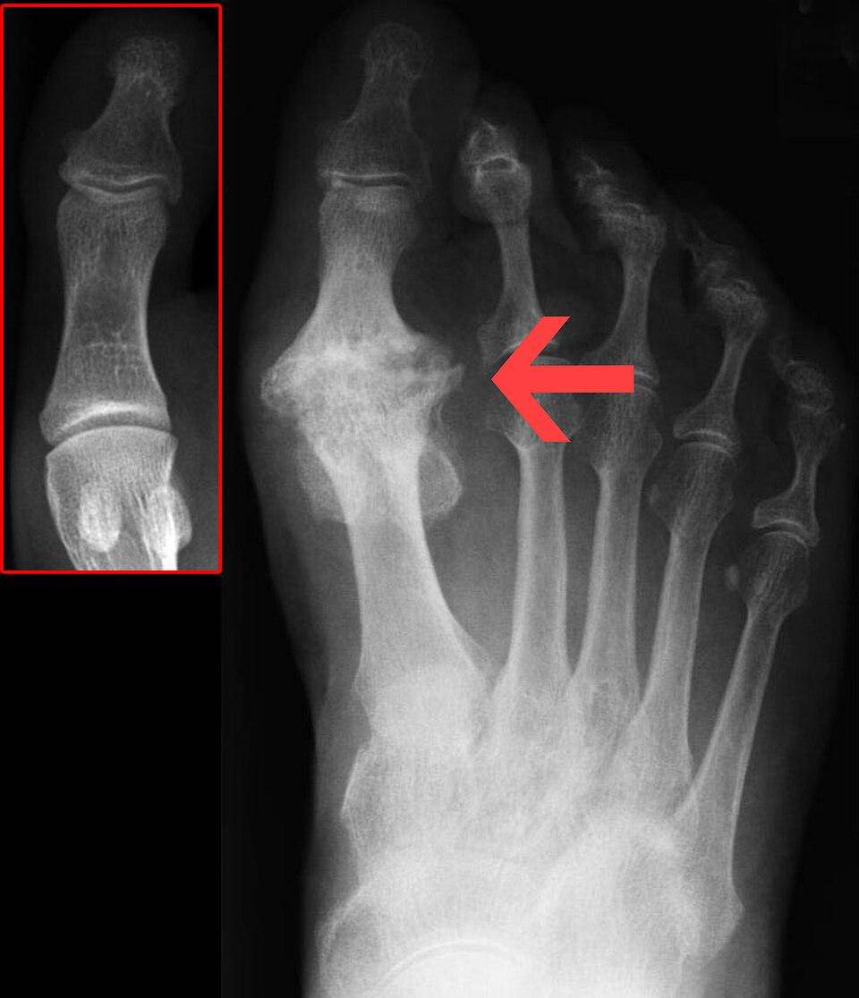 Foto rontgen yang menunjukkan hallux rigidus di jempol kaki.