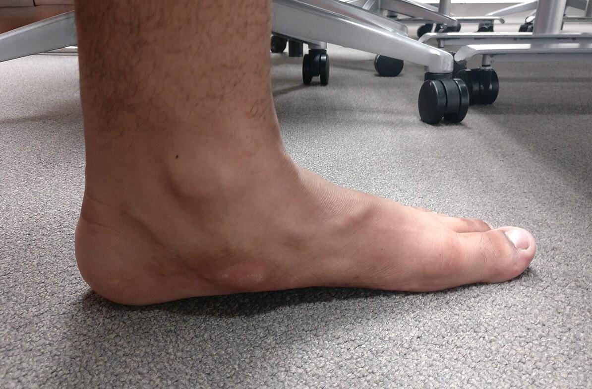 Kelainan kaki datar yang disebabkan oleh tulang navikular tambahan.