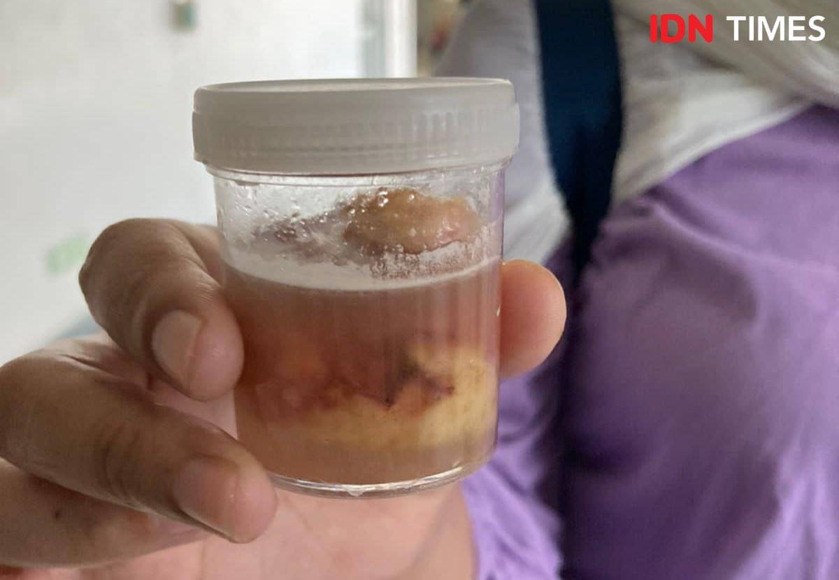 Tumor yang berhasil diangkat oleh dokter pascaoperasi pengangkatan.