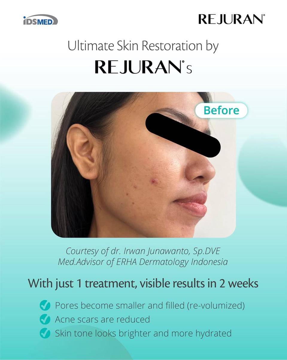 Untuk Poin 1 -✨ Ultimate Skin Restoration by Rejuran S ✨  Hanya dengan 1x treatment, hasil nyata dapat terliha.jpg