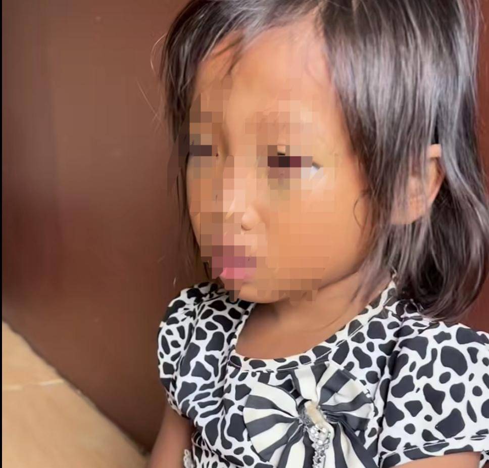 Siswa sd di Palembang alami lebam di mata dan mata memerah diduga akibat penganiayaan di sekolah (Instagram: @Virasoniaaaa)