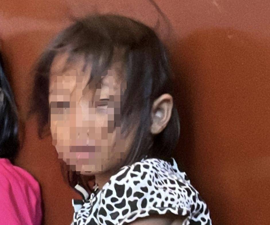 Siswa sd di Palembang alami lebam di mata dan mata memerah diduga akibat penganiayaan di sekolah.