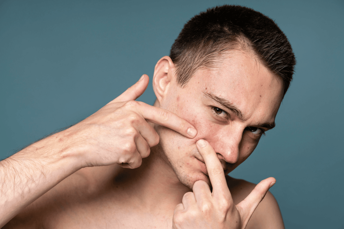 ilustrasi pria memencet jerawat