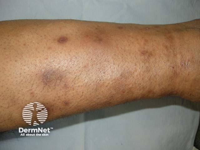 Shin spots atau diabetic dermopathy. (dermnetnz.org)