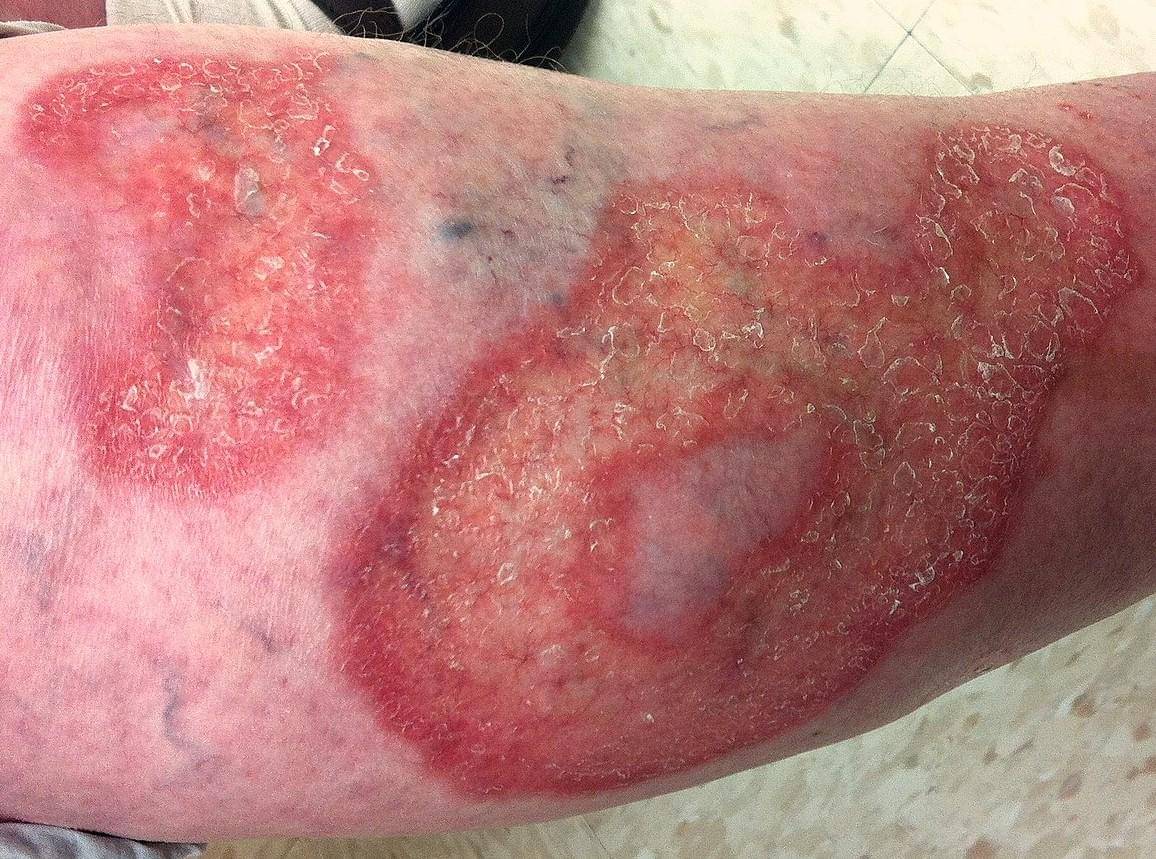 Foto lesi necrobiosis lipoidica pada kaki pasien diabetes.