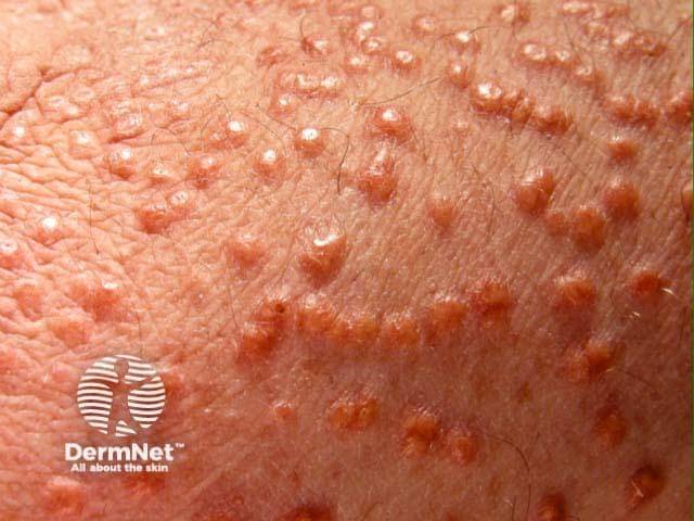 Eruptive xanthomatosis.