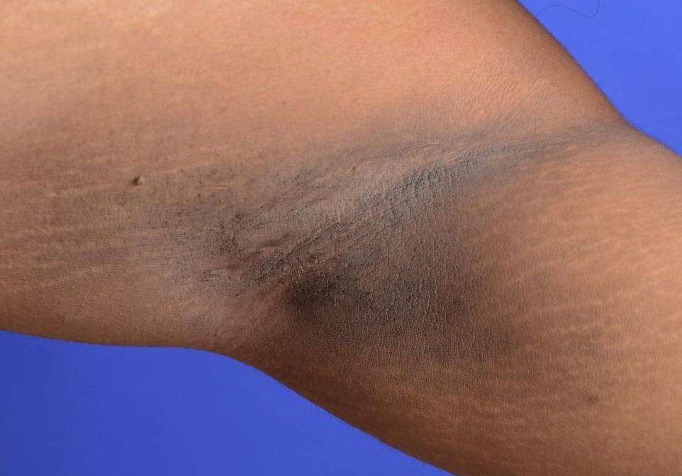 Akantosis nigrikans di ketiak.