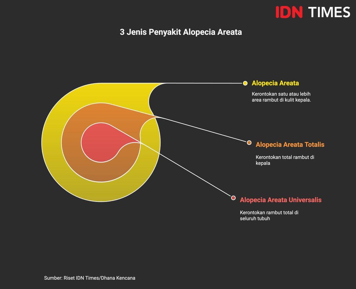 Infografis: tiga jenis penyakit alopecia. (IDN Times/Dhana Kencana)
