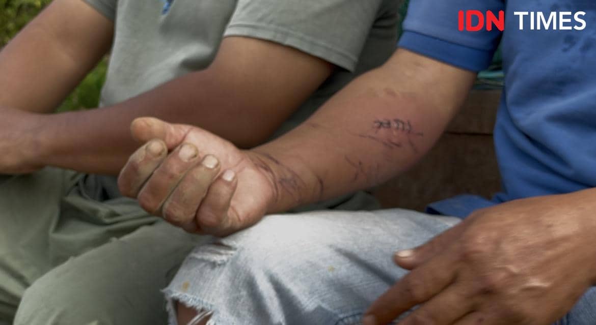 Musrizal mengalami luka akibat terjangan banjir di Kecamatan Palembayan, Kabupaten Agam, Sumbar, Kamis (27/11/2025). 