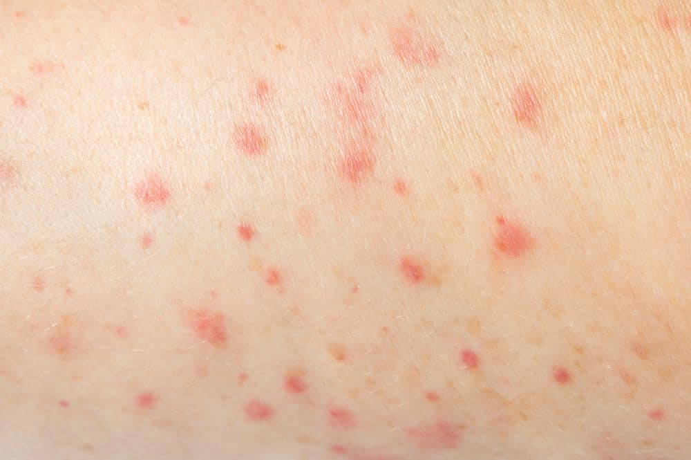 ilustrasi ruam kulit