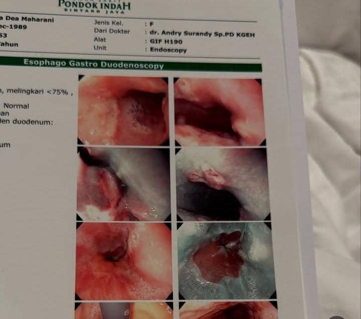 Ryana Dea dirawat karena luka di saluran pencernaan
