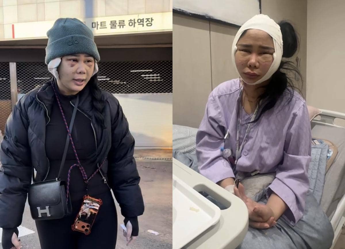 potret Denise Chariesta operasi plastik