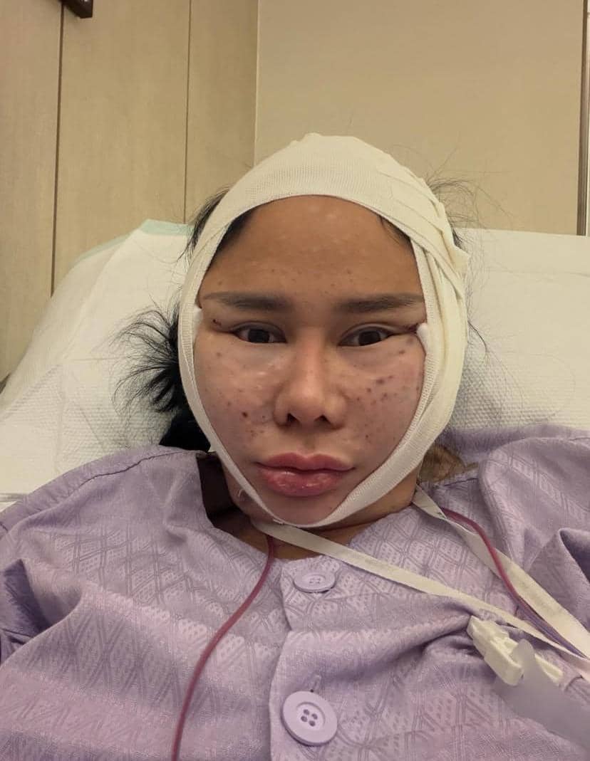 potret Denise Chariesta operasi plastik