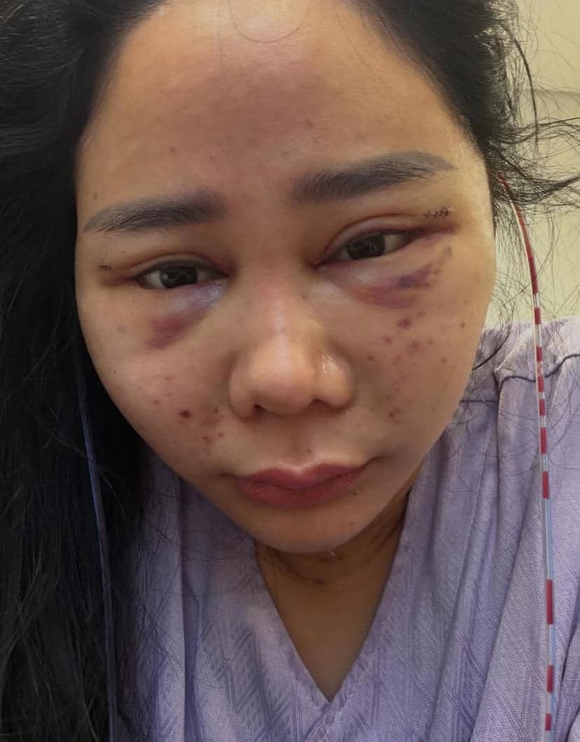 potret Denise Chariesta operasi plastik